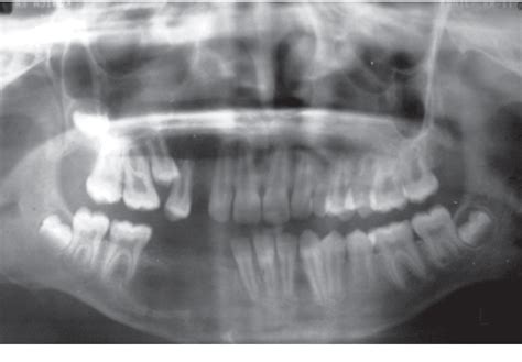 Figure 2 From Nonsyndromic Bilateral Maxillary And Unilateral