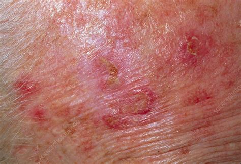 Solar Keratosis Skin Disorder Stock Image M1900047 Science Photo