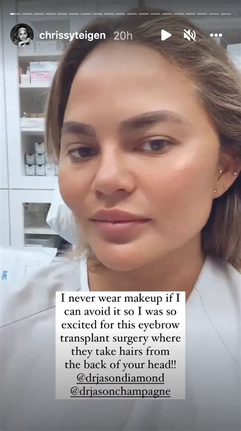 Chrissy Teigen Shows Hair Progress After Eyebrow Transplant