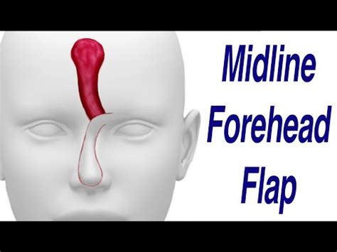Midline Forehead Flap For Nasal Defect Reconstruction YouTube
