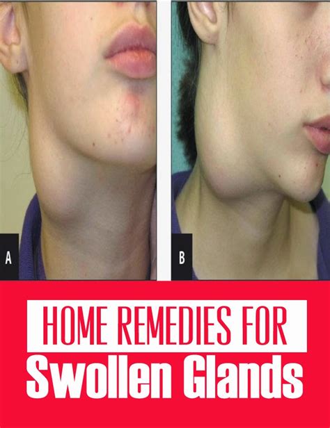 Home Remedies For Swollen Glands Cute Health