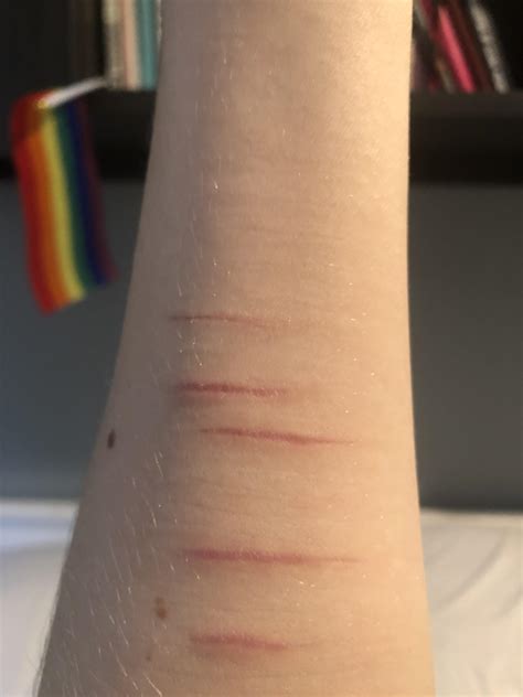 1 Best Ucherrycheeseuwu Images On Pholder Harm Scars From A Really