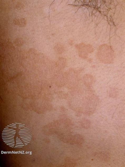 Beste Behandlungen Für Tinea Versicolor Hautinfektion Medde