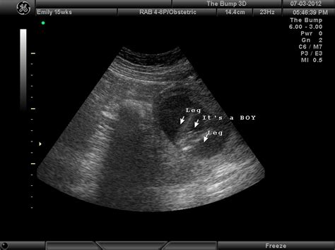 What To Expect In Ultrasound Done At 15 Weeks Pregnant New Kids Center