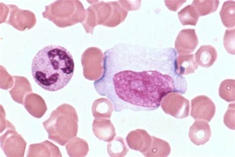 Infectious Mononucleosis Blood Smear