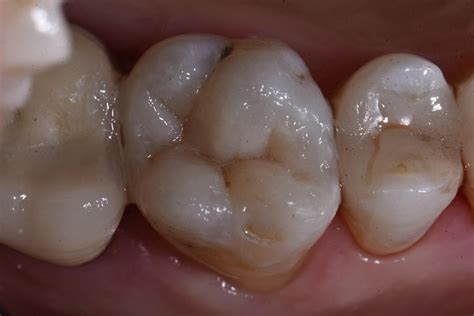 “white Amalgam” White Fillings Cosmetic Dentist Auckland