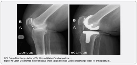 is a derived caton deschamps index for arthroplasty a reliable and valid measure of patella height
