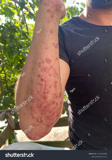 Eczema Skin Disease On Male Arm Stock Photo 2116234088 Shutterstock