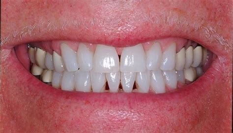 The Causes Of Plaque And Tartar Formation Sabka Dentist Top Dental