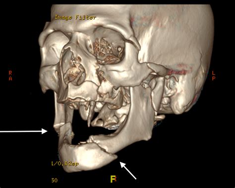 Symphysis Mandible Fracture My Xxx Hot Girl