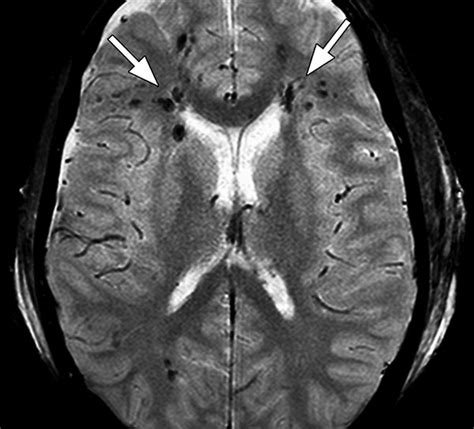 Mri has proven to be the optimal means of detection and characterization of dai lesions, with gre and flair sequences being particularly helpful, and more. Advanced Neuroradiological MRI: A Medical Imaging Aid for ...
