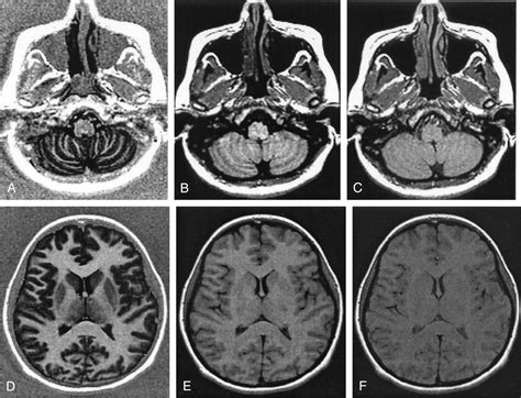 Phase Sensitive T1 Inversion Recovery Imaging A Time Efficient