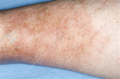 Varicose Eczema Stock Image C0017331 Science Photo Library