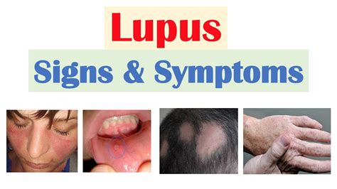 Lupus Signs And Symptoms And Why They Occur Skin Joints Organ Systems