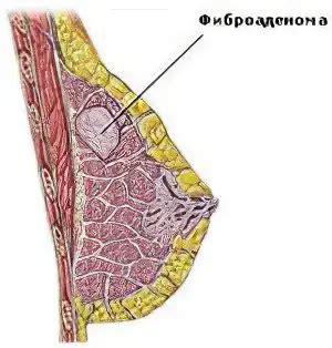 Fibroadenoma Causas S Ntomas Diagn Stico Tratamiento Y Prevenci N Del Fibroadenoma