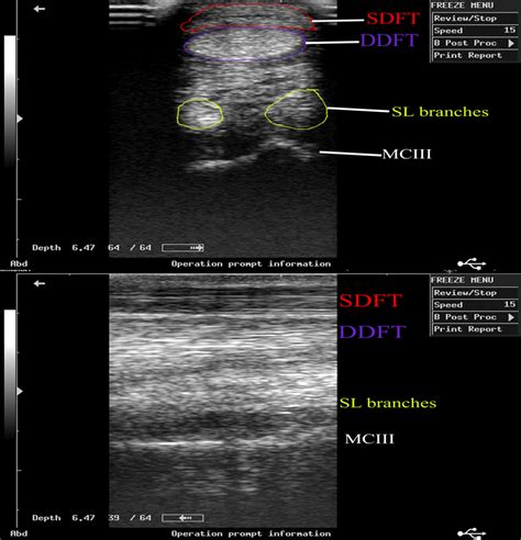 Transverse A And Longitudinal B Sonogram Of The Normal Flexor