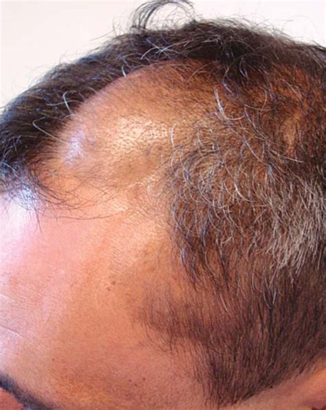 Clinical Aspect Of The Scalp Lesions Showing 3 Confluent Plaques
