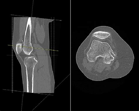 Ct Scan Of The Right Knee Showing Entry Point And Oblique Path Of
