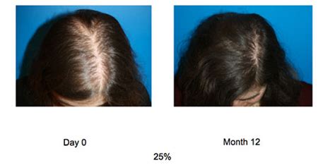 Prp Acell Hair Growth Therapy