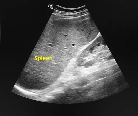 Gastrointestinal Varices Echocardiography And Ultrasound Wikidoc