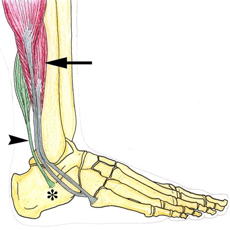 Accessory Muscles Anatomy Symptoms And Radiologic Evaluation