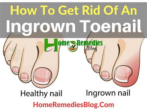 When using electric razors, some shaving techniques may help prevent ingrown hair. How To Get Rid Of An Ingrown Toenail Painlessly - Home ...