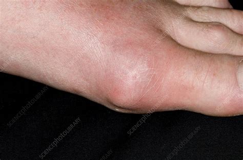 Gout Of The Big Toe Stock Image C0072726 Science Photo Library