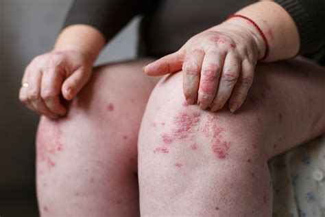 Psoriasis Symptoms Causes Treatment And Photos