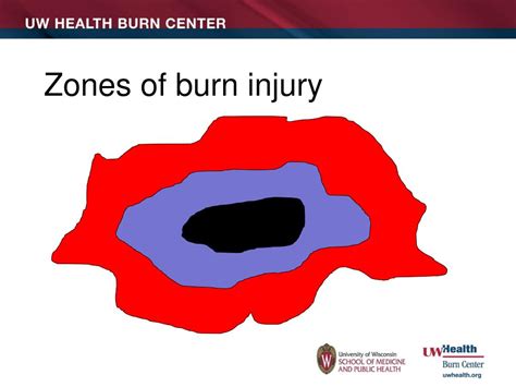 Ppt Initial Burn Care Powerpoint Presentation Free Download Id5076662