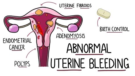 Abnormal Uterine Bleeding Aub Menorrhagia Heavy Menstrual Bleeding Including Mnemonic