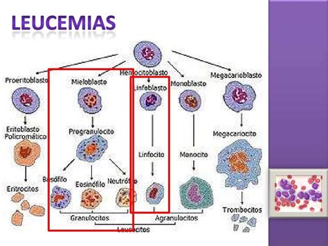 Leucemia Linfoblástica Aguda