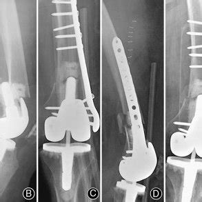 Periprosthetic distal femur fractures (Su type I, Rorabeck ...