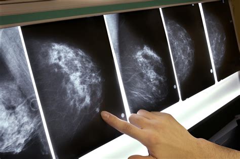 Got Dense Breasts That Can Depend On Who Is Reading The Mammogram