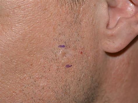Figure 1 From Basal Cell Carcinoma Mimicking Desmoplastic