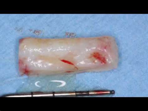Harvesting Connective Tissue Graft From Palate Case Report Youtube