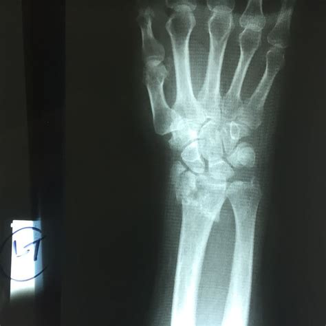 Broken Hand X Ray Broken Wrist Decor Photography