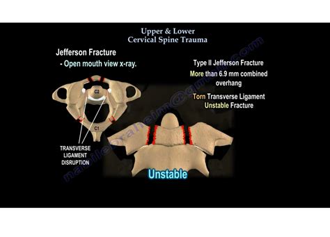 Cervical Spine Injuries —