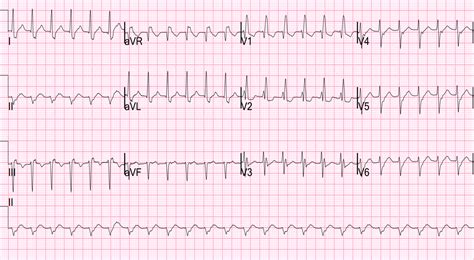 Dr Smiths Ecg Blog Paroxysmal Svt Psvt That Repeatedly Recurs In