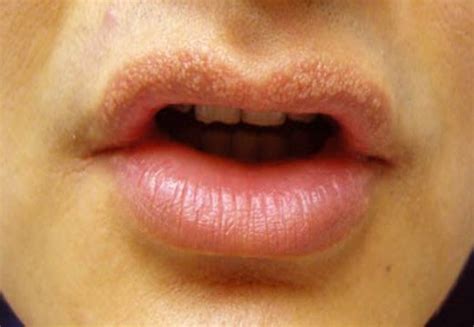 White Bumps On Lips Causes And Treatment Vitamin Resource