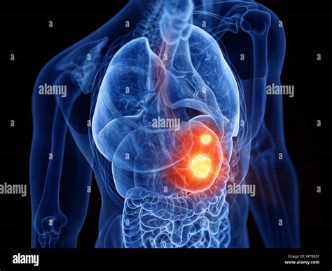 Esophagus Cancer Hi Res Stock Photography And Images Alamy