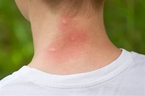 How To Recognize And Treat The 15 Most Common Bug Bites Zeptha