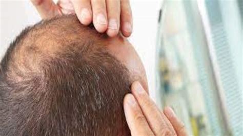 Signs Of Balding And Its Stages What To Do If Your Head Becomes Bald
