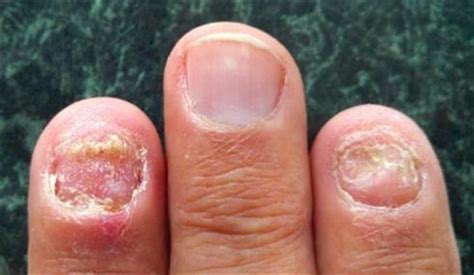 Nail Diseases Conditions And Disorders Flashcards Quizlet