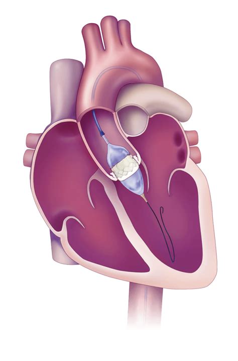 Tavr Heart Valve Replacement Procedure Steps And Surgery Time