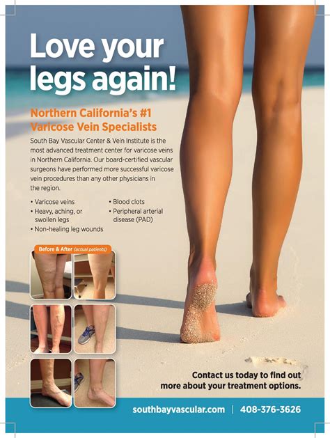 Northern Californias Number 1 Varicose Vein Treatment Center Archives