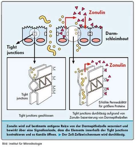 Hier kann es sein, dass die ausscheidungen durch polypen, verwachsungen oder aufgrund eines tumors im darm zu wenig platz haben. Leaky Gut Syndrom - Leaky Gut Behandlung | Praxis Fabian ...