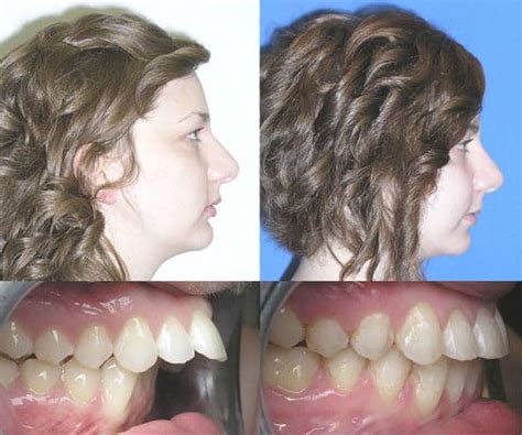 Overbite Before And After Braces Top Pictures And More 2024 Bracesboss