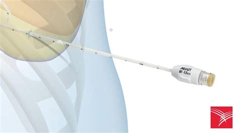 One Step Centesis Drainage Catheters Youtube