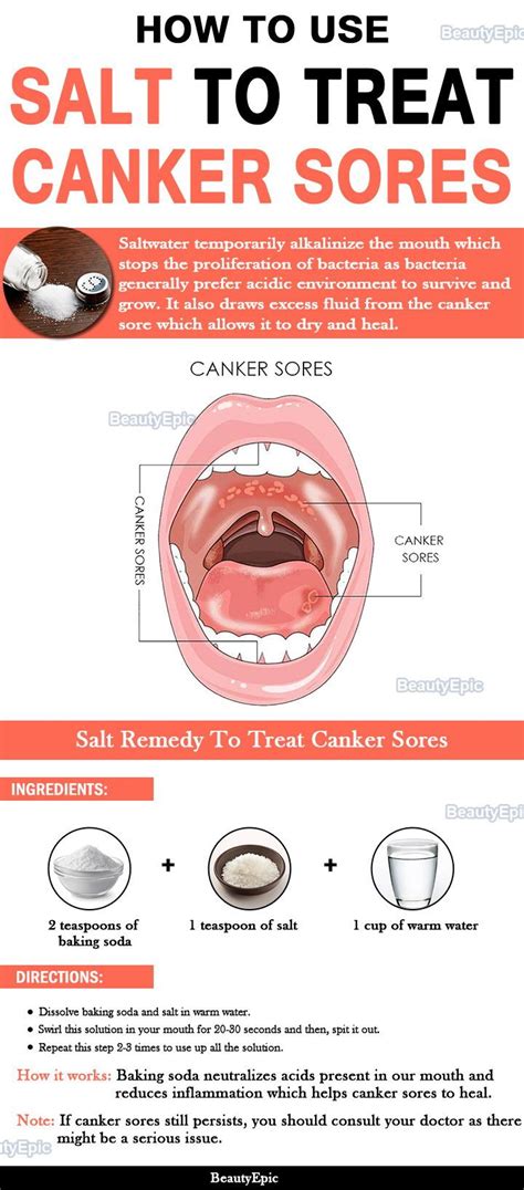How To Cure Canker Sore At Home Home And Garden Reference