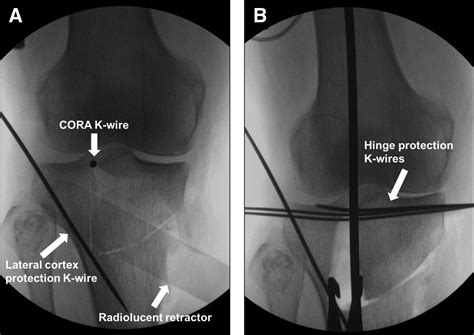 Distal Tibial Tuberosity Focal Dome Osteotomy Combined With Intra